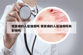 銀屑病的人能抽煙嗎 銀屑病的人能抽煙嗎有影響嗎