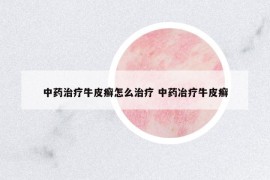 中藥治療牛皮癬怎么治療 中藥冶療牛皮癬