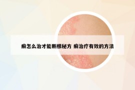 癬怎么治才能斷根秘方 癬治療有效的方法