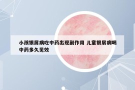 小孩銀屑病吃中藥出現(xiàn)副作用 兒童銀屑病喝中藥多久見效