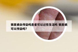 銀屑病會傳染嗎患者可以過性生活嗎 銀屑病可以傳染嗎?