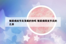 銀屑病關(guān)節(jié)炎發(fā)展的快嗎 銀屑病得關(guān)節(jié)炎的幾率