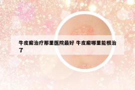 牛皮廨治療那里醫(yī)院最好 牛皮廨哪里能根治了