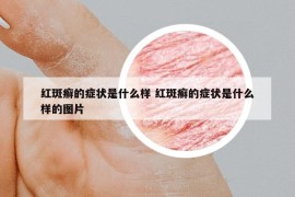 紅斑癬的癥狀是什么樣 紅斑癬的癥狀是什么樣的圖片
