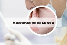 銀屑病醫(yī)院建都 銀屑病什么醫(yī)院有名