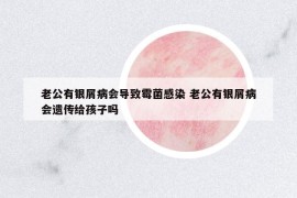 老公有銀屑病會導致霉菌感染 老公有銀屑病會遺傳給孩子嗎