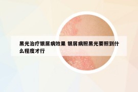 黑光治療銀屑病效果 銀屑病照黑光要照到什么程度才行