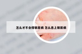 怎么才不會(huì)得銀屑病 怎么患上銀屑病