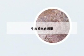 牛皮癬出自哪里