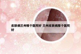 皮膚病蘭州哪個醫(yī)院好 蘭州皮膚病那個醫(yī)院好