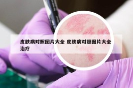 皮膚病對照圖片大全 皮膚病對照圖片大全 治療