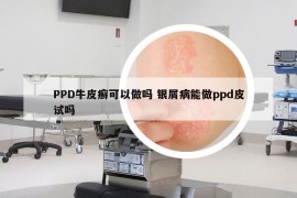 PPD牛皮癬可以做嗎 銀屑病能做ppd皮試嗎