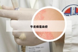 牛皮癬是血瘀