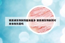 銀屑病生物制劑越來越多 銀屑病生物制劑對身體有傷害嗎