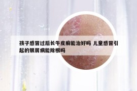 孩子感冒過后長牛皮癬能治好嗎 兒童感冒引起的銀屑病能除根嗎