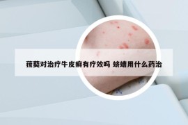 菝葜對(duì)治療牛皮癬有療效嗎 蠐螬用什么藥治