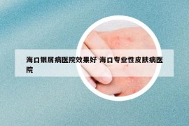 海口銀屑病醫(yī)院效果好 ?？趯I(yè)性皮膚病醫(yī)院
