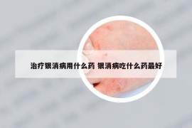 治療銀消病用什么藥 銀消病吃什么藥最好
