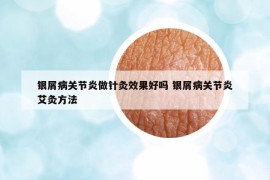 銀屑病關(guān)節(jié)炎做針灸效果好嗎 銀屑病關(guān)節(jié)炎艾灸方法