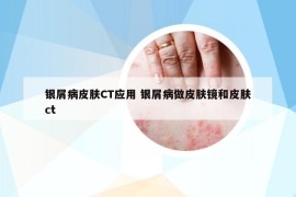 銀屑病皮膚CT應(yīng)用 銀屑病做皮膚鏡和皮膚ct