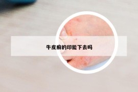 牛皮癬的印能下去嗎