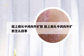 腿上癬從中間向外擴(kuò)散 腿上癬從中間向外擴(kuò)散怎么回事