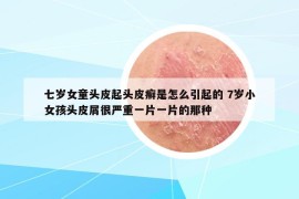 七歲女童頭皮起頭皮癬是怎么引起的 7歲小女孩頭皮屑很嚴(yán)重一片一片的那種