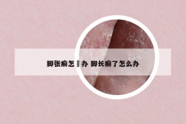 腳張癬怎麼辦 腳長癬了怎么辦