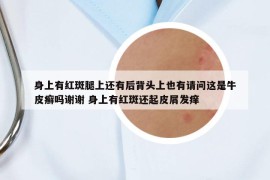 身上有紅斑腿上還有后背頭上也有請(qǐng)問(wèn)這是牛皮癬嗎謝謝 身上有紅斑還起皮屑發(fā)癢