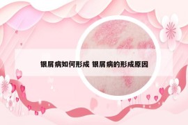 銀屑病如何形成 銀屑病的形成原因