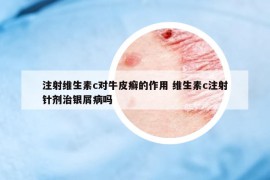 注射維生素c對(duì)牛皮癬的作用 維生素c注射針劑治銀屑病嗎