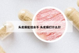 頭皮癬能掛水不 頭皮癬打什么針