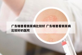 廣東哪里看銀屑病比較好 廣東哪里看銀屑病比較好的醫(yī)院