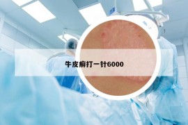 牛皮癬打一針6000