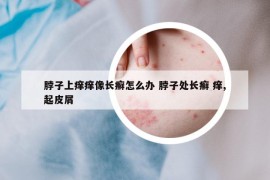 脖子上癢癢像長癬怎么辦 脖子處長癬 癢,起皮屑