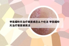 甲氨蝶呤片治療銀屑病怎么個吃法 甲氨蝶呤片治療銀屑病用法