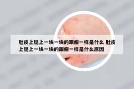 肚皮上腿上一塊一塊的跟癬一樣是什么 肚皮上腿上一塊一塊的跟癬一樣是什么原因