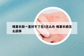嘴里長蘚一直好不了在3怎么辦 嘴里長癬怎么回事