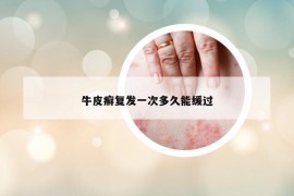 牛皮癬復發(fā)一次多久能緩過