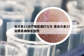 白介素23治療銀屑病打幾針 用白介素17治銀屑病哪些醫(yī)院