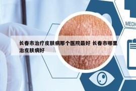 長春市治療皮膚病那個醫(yī)院最好 長春市哪里治皮膚病好