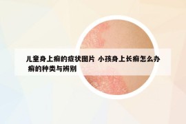 兒童身上癬的癥狀圖片 小孩身上長(zhǎng)癬怎么辦 癬的種類與辨別