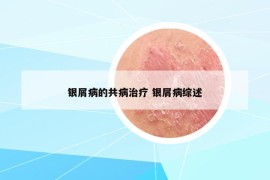 銀屑病的共病治療 銀屑病綜述