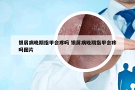 銀屑病晚期指甲會(huì)疼嗎 銀屑病晚期指甲會(huì)疼嗎圖片