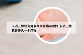 卡泊三醇軟膏用多久牛皮癬可以好 卡泊三醇軟膏多久一個(gè)療程
