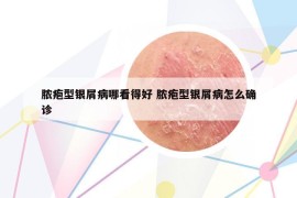 膿皰型銀屑病哪看得好 膿皰型銀屑病怎么確診