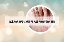 兒童頭皮癬可以根治嗎 兒童頭皮蘚怎么根治
