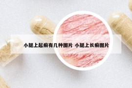 小腿上起癬有幾種圖片 小腿上長癬圖片