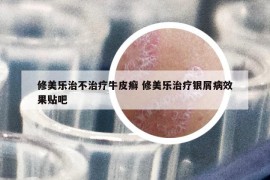 修美樂治不治療牛皮癬 修美樂治療銀屑病效果貼吧