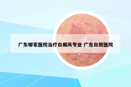 廣東哪家醫(yī)院治療白癜風(fēng)專業(yè) 廣東白斑醫(yī)院